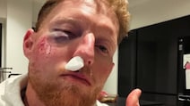 Ben Stokes Suffers Serious Injury After Being Struck By Ball During Training