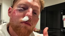 'Cricket Balls Do Serious Damage': Stokes Makes Big Vow After Facial Injury