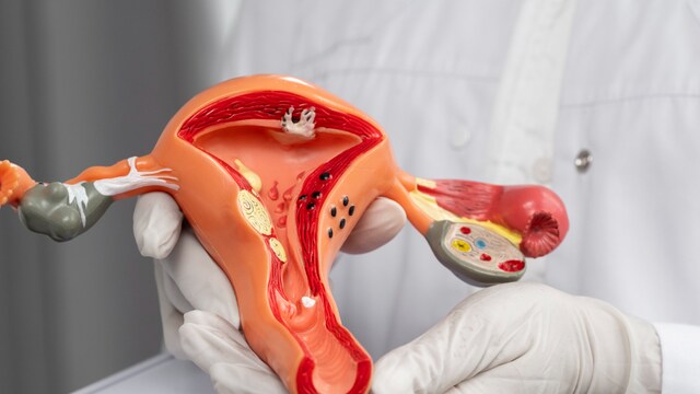 The relationship between endometriosis and fertility needs personal assessment