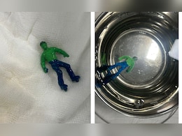 खेल-खेल में बच्चे ने निगला हल्क खिलौना, बिना ऑपरेशन डॉक्टरों ने ऐसे  बचाई जान