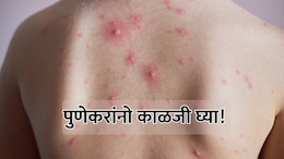 Pune News: पुणेकरांनो काळजी घ्या! 'चिकनपॉक्स'च्या साथीने नागरिक चिंतेत, रुग्णांमध्ये मोठी वाढ