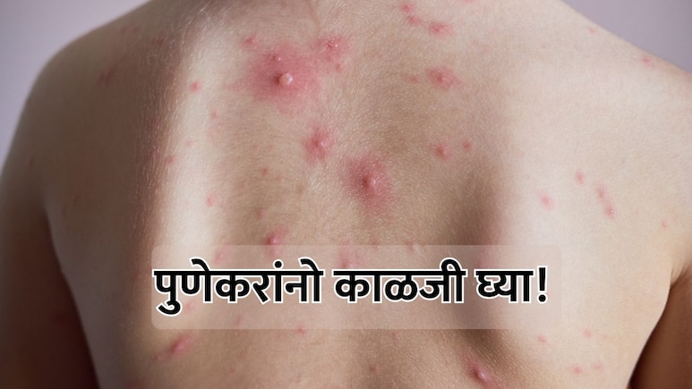Pune News: पुणेकरांनो काळजी घ्या! 'चिकनपॉक्स'च्या साथीने नागरिक चिंतेत, रुग्णांमध्ये मोठी वाढ