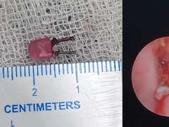 निमोनिया मान करा रहे थे मासूम का इलाज,ऑपरेशन में जो निकला वो आपके होश उड़ा देगा,VIDEO