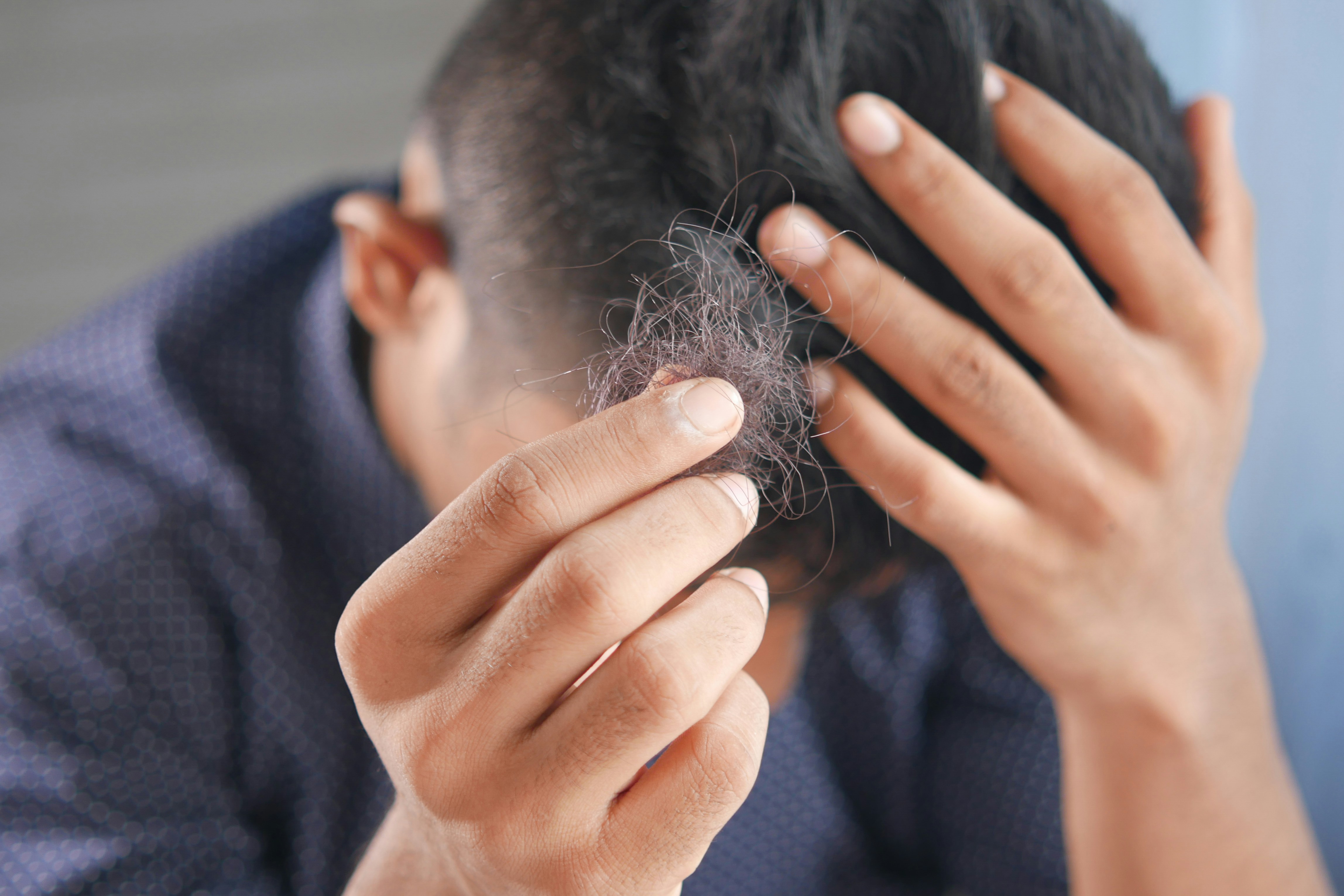 Hair shedding can turn into hair loss if the frequency of losing hair strands is too much