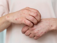 Silent Fatty Liver: 6 Skin Changes That Mean Your Liver Is Struggling