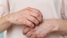 Silent Fatty Liver: 6 Skin Changes That Mean Your Liver Is Struggling