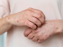 Silent Fatty Liver: 6 Skin Changes That Mean Your Liver Is Struggling