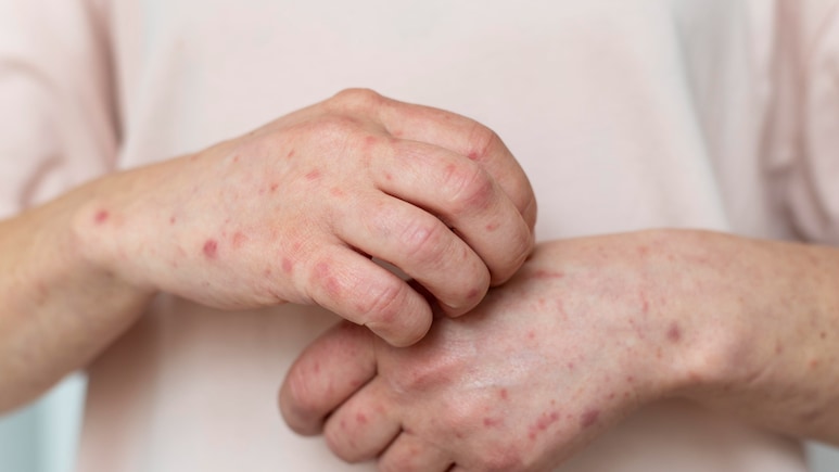 Silent Fatty Liver: 6 Skin Changes That Mean Your Liver Is Struggling