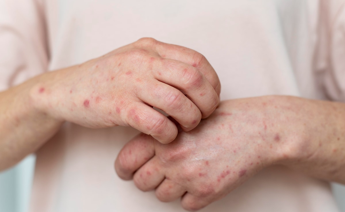 Silent Fatty Liver: 6 Skin Changes That Mean Your Liver Is Struggling