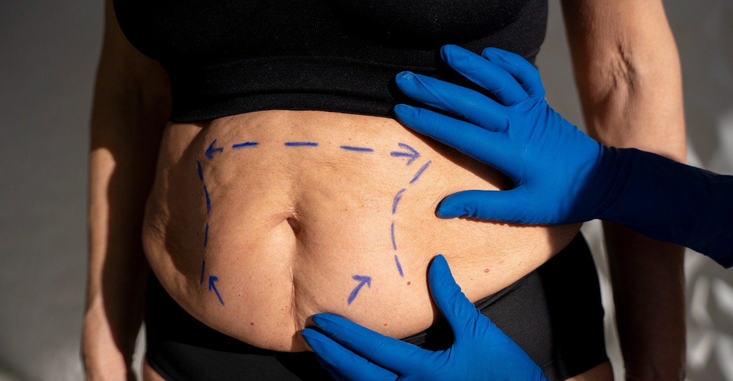 Weight-Loss Surgery May Protect Heart More Than Drugs Like Ozempic: Study