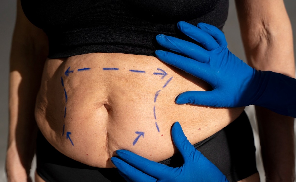 Weight-Loss Surgery May Protect Your Heart More Than Drugs Like Ozempic, Mounjaro: Study