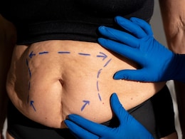 Weight-Loss Surgery May Protect Your Heart More Than Drugs Like Ozempic, Mounjaro: Study