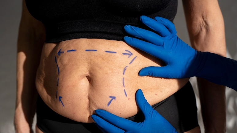 Weight-Loss Surgery May Protect Your Heart More Than Drugs Like Ozempic, Mounjaro: Study