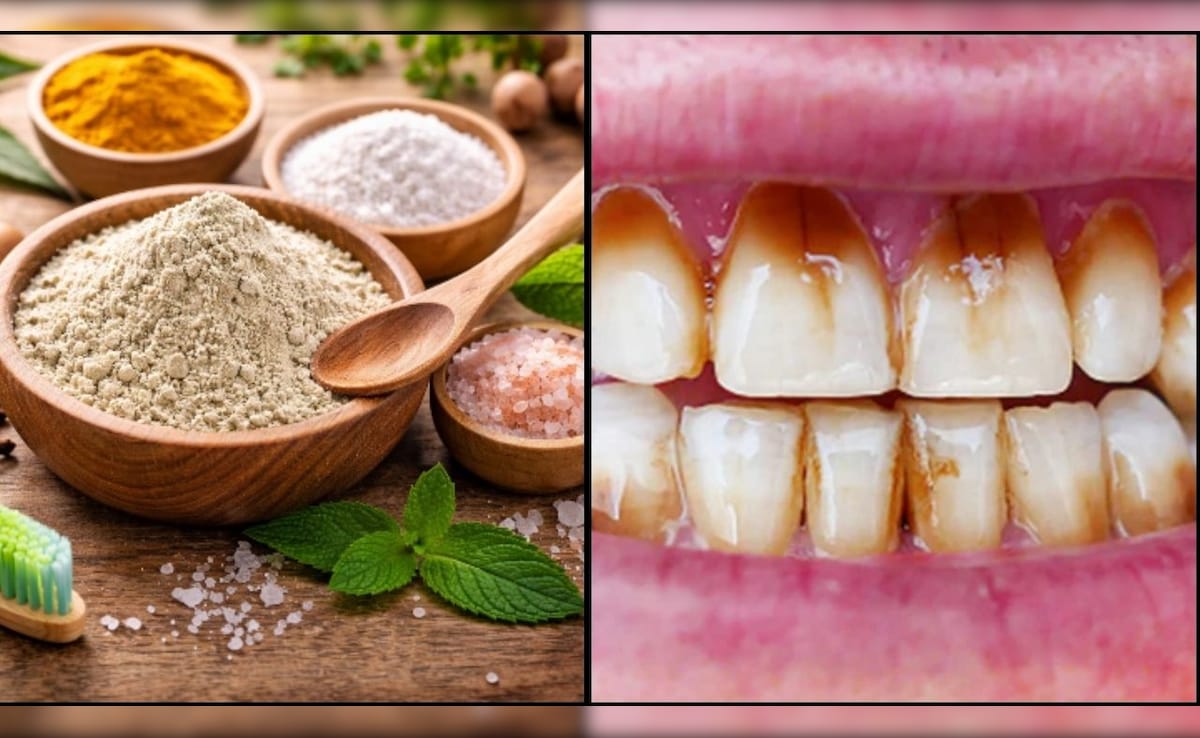 डॉक्टर सलीम जैदी ने बताया पीले दांतों को चमकाने का घरेलू हर्बल पाउडर, कैविटी, दर्द और दाग धब्बे हो जाएंगे गायब
