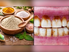 डॉक्टर सलीम जैदी ने बताया पीले दांतों को चमकाने का घरेलू हर्बल पाउडर, कैविटी, दर्द और दाग धब्बे हो जाएंगे गायब