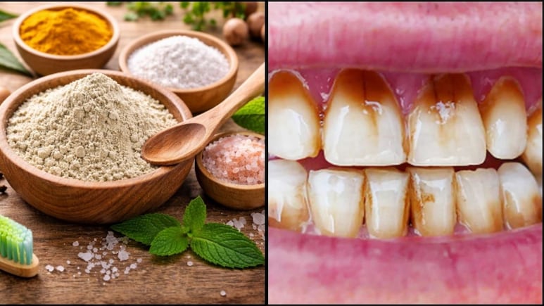 डॉक्टर सलीम जैदी ने बताया पीले दांतों को चमकाने का घरेलू हर्बल पाउडर, कैविटी, दर्द और दाग धब्बे हो जाएंगे गायब