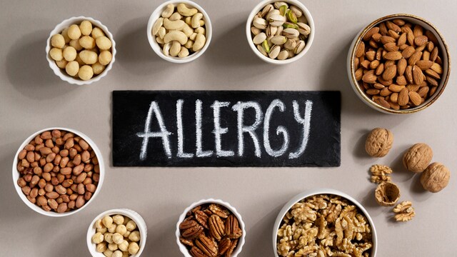 Nearly 1 in 20 children globally has food allergies and their signs are distinctly visible