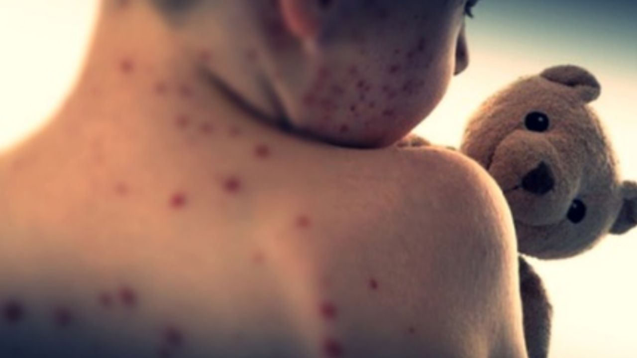 Balaghat Outbreak: No New Measles Case In 7 Days, Says Centre