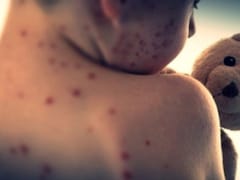 मंगोलिया में खसरे का विस्फोट, संक्रमितों की संख्या 14,000 के पार, स्कूल जाने वाले बच्चे सबसे ज्यादा प्रभावित