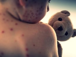 100 Children Dead In Bangladesh Measles Outbreak: What Led To Sudden Surge?