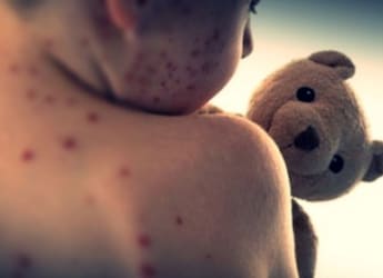 Bangladesh Measles Outbreak Deaths Reach 585 As 2 More Children Die