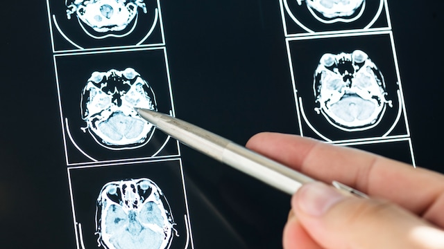 Cognitive slowdowns should not be underestimated