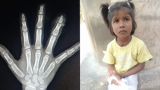 खौफनाक! स्कूल मे मिड डे मील के दौरान कटीं 6 साल की बच्ची की उंगलियां, स्कूल स्टाफ ने फेंक दिया