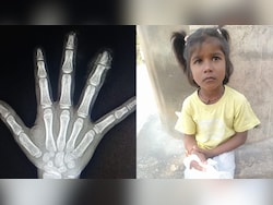 Girl's Fingers Cut Off In Karnataka School, Parents Allege Staff Threw Them Away