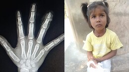 Girl's Fingers Cut Off In Karnataka School, Parents Allege Staff Threw Them Away
