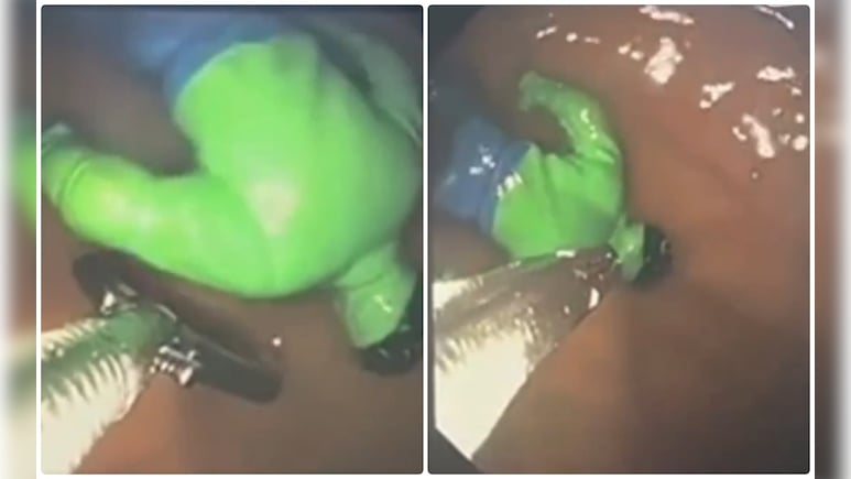 बच्चे ने निगला HULK! ऑपरेशन करने वाले डॉक्टर भी हैरान, देखिए