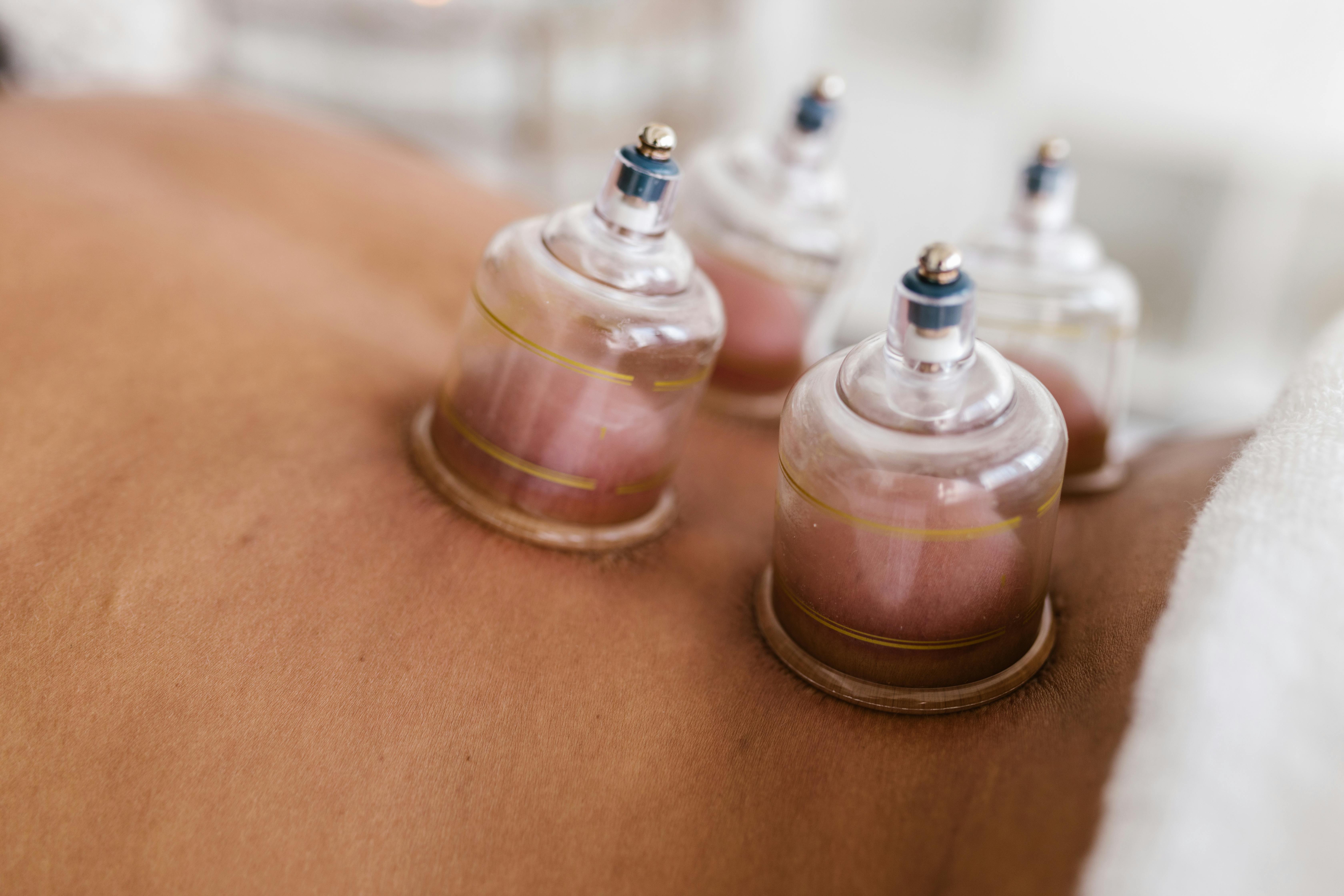 Cupping is a form of alternative therapy that involves placing special cups on the skin.