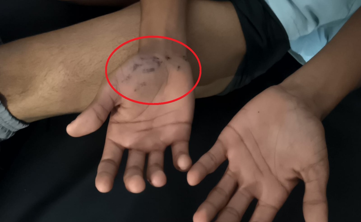 9वीं के स्टूडेंट को टीचर ने पीटा; सागर के मिशनरी स्कूल में होमवर्क नहीं दिखाने पर मिली सजा, केस दर्ज