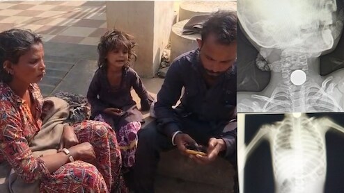 Guna District Hospital: गरीब मासूम के गले में फंसा 5 का सिक्का, &nbsp;जिला अस्पताल ने भगाया, &nbsp;बोले-हमारे पास मशीन और डॉक्टर नहीं है !