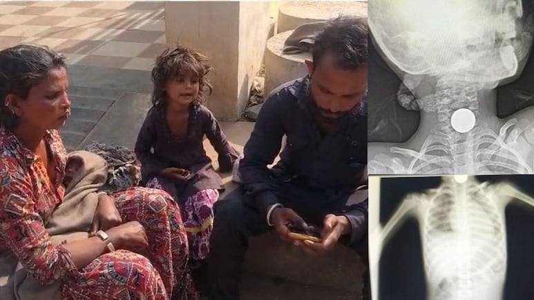 Guna District Hospital: गरीब मासूम के गले में फंसा 5 का सिक्का, &nbsp;जिला अस्पताल ने भगाया, &nbsp;बोले-हमारे पास मशीन और डॉक्टर नहीं है !