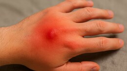 Spider Bite Reality Check: No Spider-Man Powers, Just Pain And Swelling