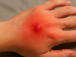 Spider Bite Reality Check: No Spider-Man Powers, Just Pain And Swelling