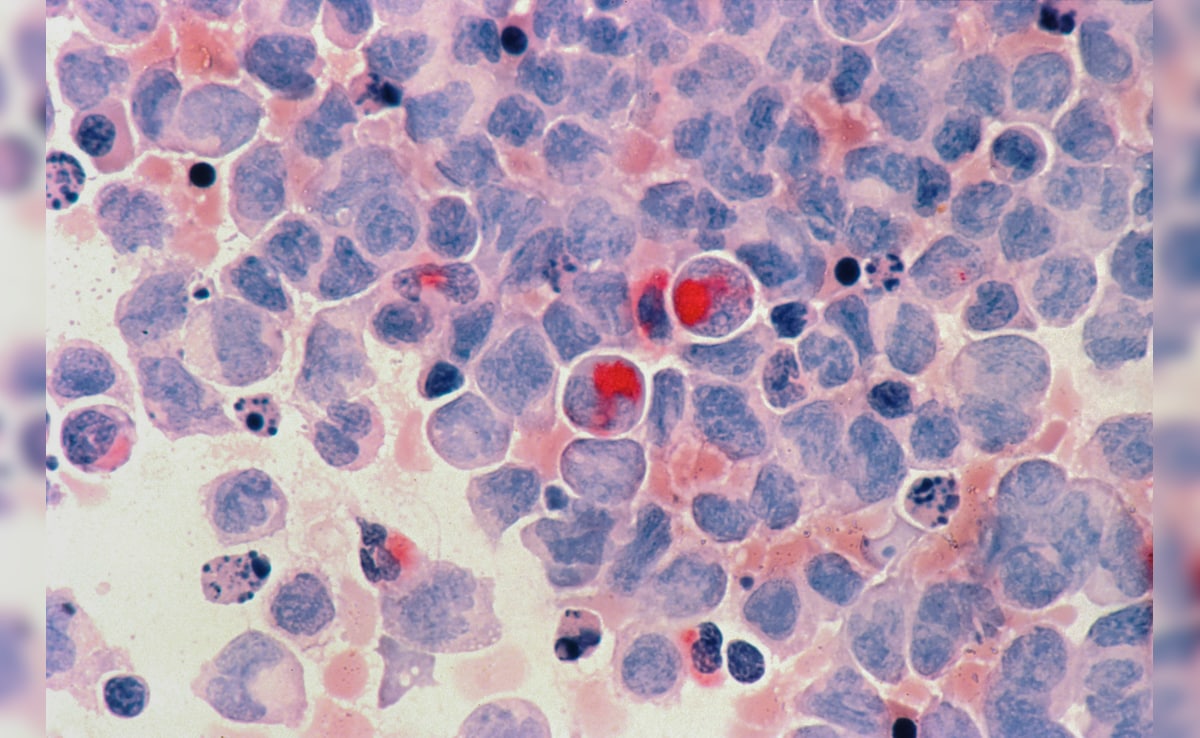 No More Expensive Treatments? Scientists Create Cancer-Fighting Cells Inside Body