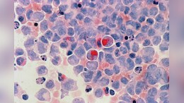 No More Expensive Treatments? Scientists Create Cancer-Fighting Cells Inside Body