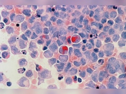 No More Expensive Treatments? Scientists Create Cancer-Fighting Cells Inside Body