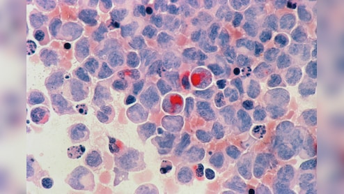 No More Expensive Treatments? Scientists Create Cancer-Fighting Cells Inside Body