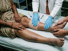 57-Year-Old Maharashtra Woman Nearly Loses Leg To Acute Limb Ischemia: Sudden Severe Pain Can Be A Vascular Emergency