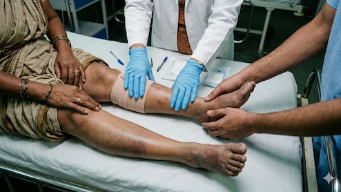 57-Year-Old Maharashtra Woman Nearly Loses Leg To Acute Limb Ischemia: Sudden Severe Pain Can Be A Vascular Emergency