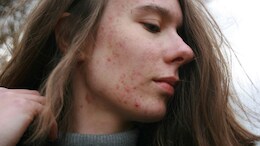 Why Your Skin Gets Extra Sensitive In Spring, Dietitian Explains How To Deal With It