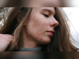 Why Your Skin Gets Extra Sensitive In Spring, Dietitian Explains How To Deal With It