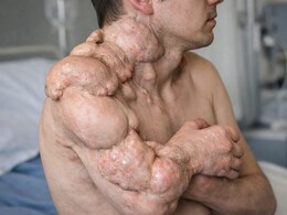 राजस्थान में पत्थर बन रहा 9 साल का बच्चा: डॉक्टर बोले-प्रदेश में यह दुर्लभ बीमारी का पहला केस; कोई इलाज नहीं