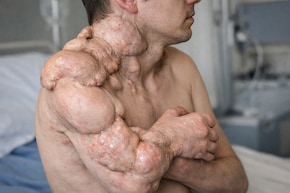 राजस्थान में पत्थर बन रहा 9 साल का बच्चा: डॉक्टर बोले-प्रदेश में यह दुर्लभ बीमारी का पहला केस; कोई इलाज नहीं