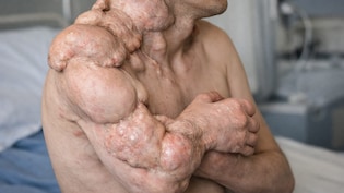 राजस्थान में पत्थर बन रहा 9 साल का बच्चा: डॉक्टर बोले-प्रदेश में यह दुर्लभ बीमारी का पहला केस; कोई इलाज नहीं