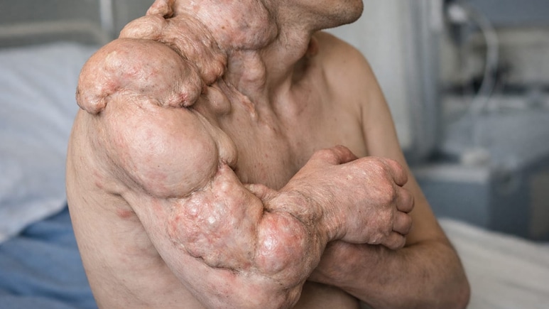 राजस्थान में पत्थर बन रहा 9 साल का बच्चा: डॉक्टर बोले-प्रदेश में यह दुर्लभ बीमारी का पहला केस; कोई इलाज नहीं