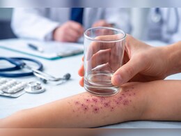 कांच के गिलास से मेनिन्जाइटिस का आसान टेस्ट, NHS ने बताया घरेलू तरीका, जानिए कैसे बच सकती है जान