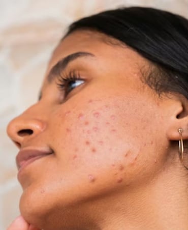 Best Foods That Reduce Skin Inflammation